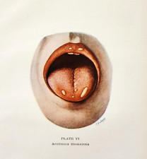 1943 Aphthous Stomatitis Medical Plate Pediatrics Mouth Ulcers Zahorsky Mouth picture