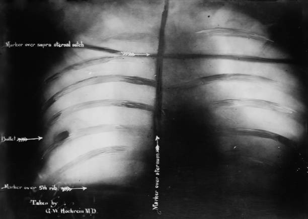 Theodore Roosevelt's chest x-ray after John F Schrank's attempted - Old Photo