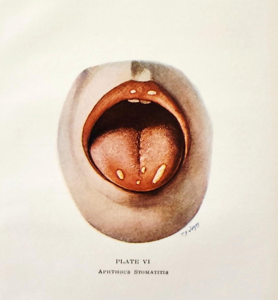 1943 Aphthous Stomatitis Medical Plate Pediatrics Mouth Ulcers Zahorsky Mouth